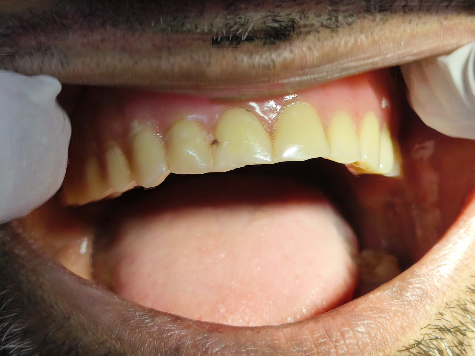After implant treatment